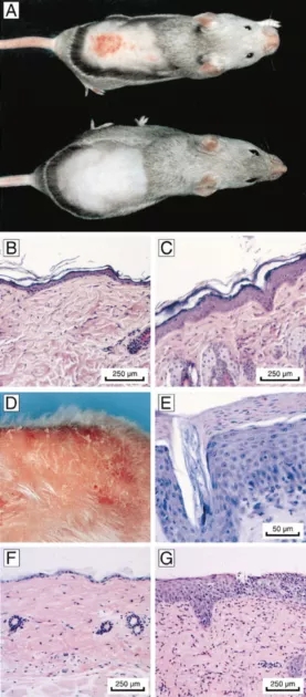 罕见的儿童早衰症—科凯恩氏综合症与ERCC6基因