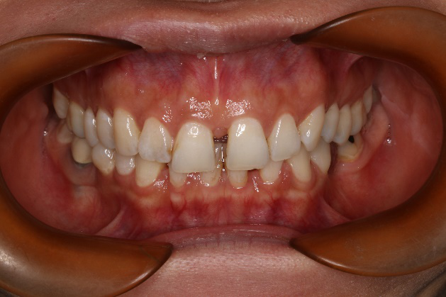 牙齿深复合图片