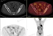 【高尚病例】18F-FDG PET/CT 诊断骨纤维异常增殖症 2 例