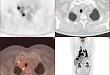 【高尚病例】PET/CT-MR 诊断结节病双肺及全身多发淋巴结广泛累及 1 例