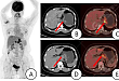 【高尚病例】胃肝样腺癌，胃癌，还是肝癌？PET/CT 找「真凶」