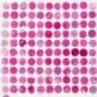 生存期肝癌组织芯片