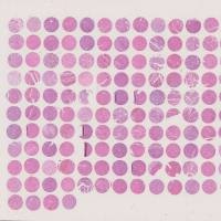 生存期肝癌组织芯片 96例