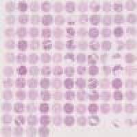 生存期胰腺癌组织芯片