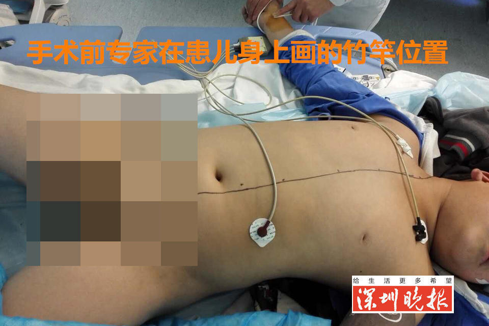 竹棍从10岁男童大腿根部插入贯穿心脏