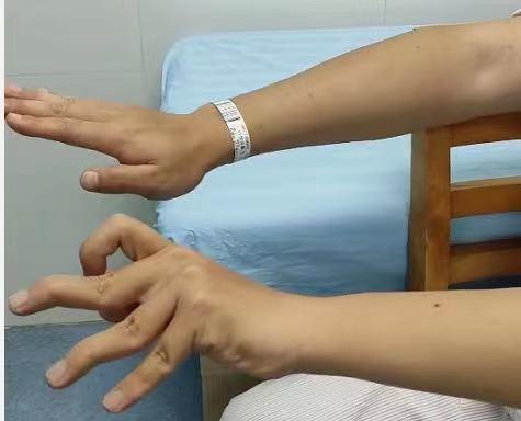 「痉挛性脑瘫」患者幼时失治, 20 年后矫正「畸形」解病痛