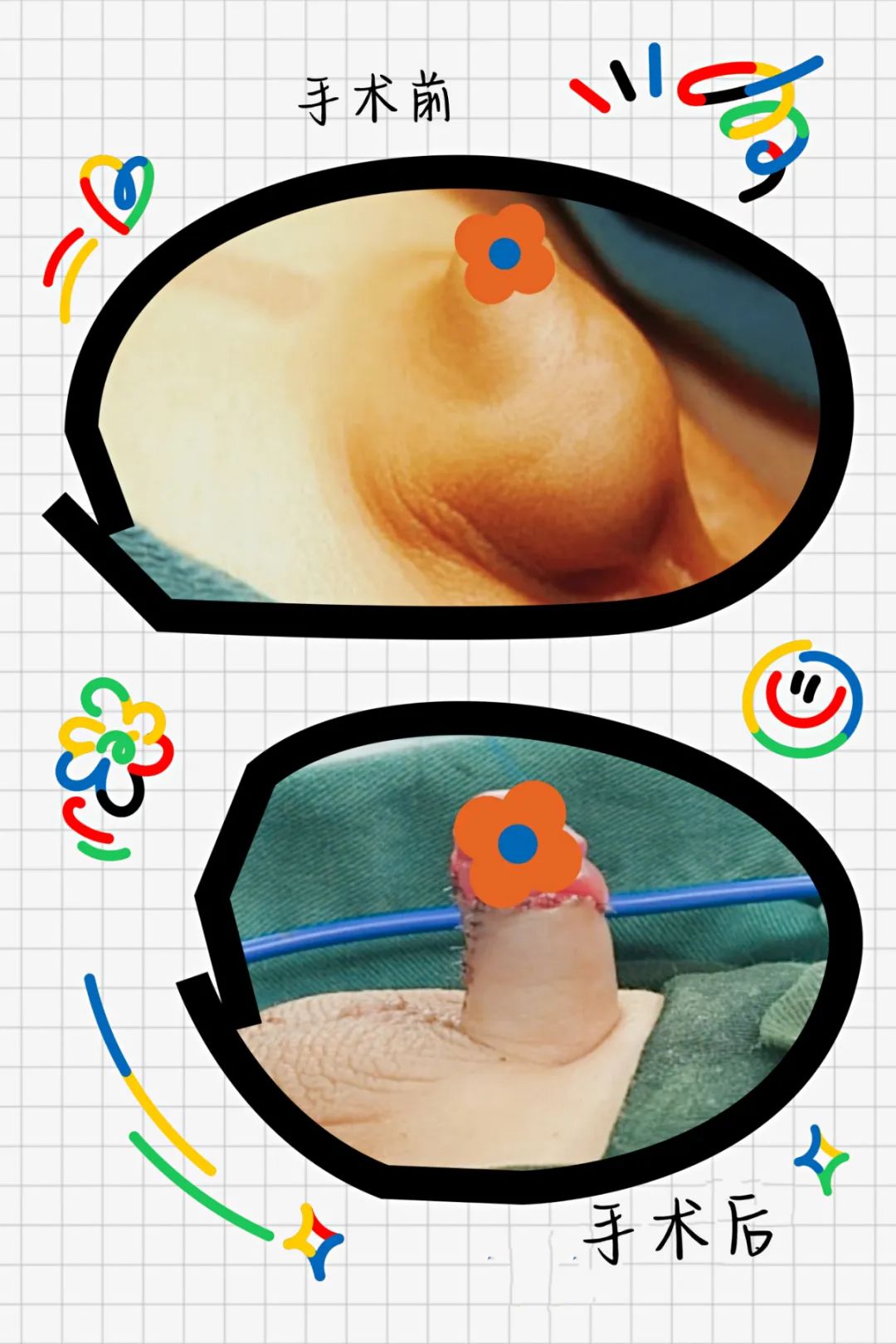 我的孩子出生时,小丁丁只有花生米大小