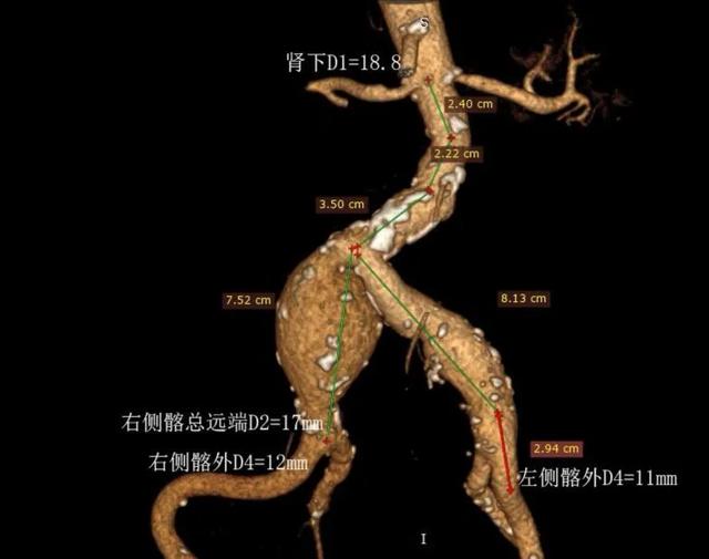 【好消息】岳池县人民医院普外一科成功开展首例大动脉瘤微创介入手术！