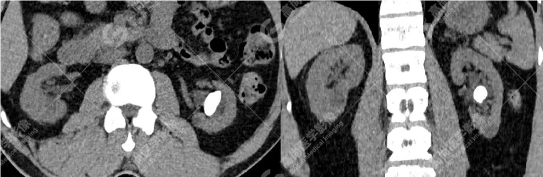 高尚病例:双能量 CT 成像分析泌尿系结石成分