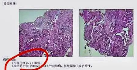 上海圆和新永门诊部：家族遗传结直肠腺瘤转腺癌治疗分享