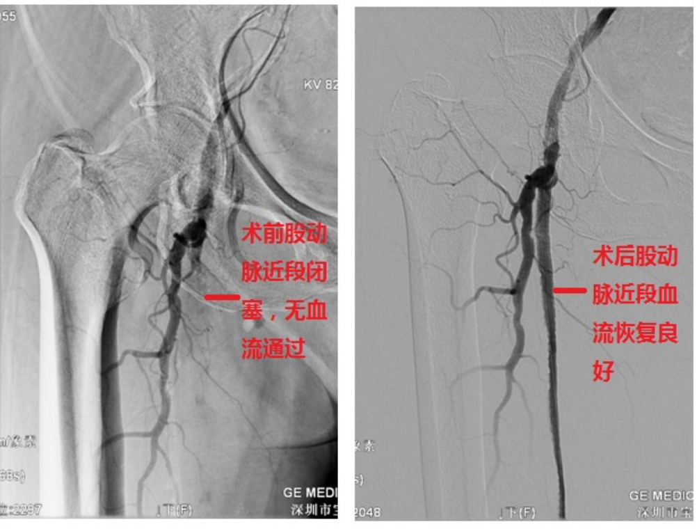 深圳市宝安区人民医院为一阿婆治疗下肢动脉硬化性闭塞症