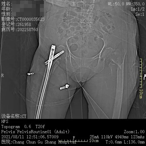 长春骨伤医院顺利为 84 岁高龄老人完成「左侧股骨粗隆间骨折闭合复位内固定手术」