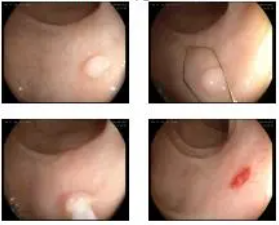 此「圈套」非彼「圈套」,治疗这类人群更安全、更高效