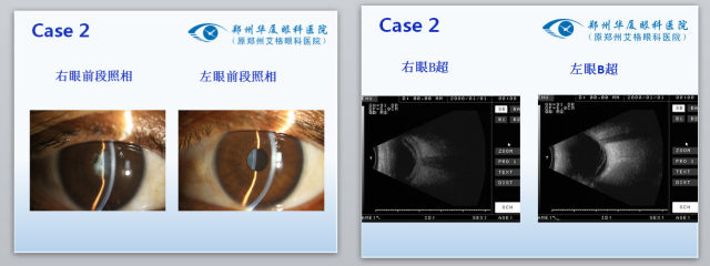 眼科专家门愿如：艾滋病玻璃体视网膜病变的手术治疗