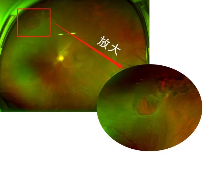 创新复杂玻璃体视网膜疾病手术方式，打造世界眼科领域「深圳样板」