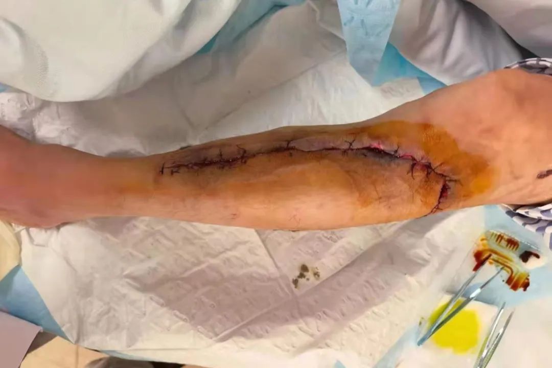 钢板戳出体外竟整整拖了 14 年，这位大伯太「硬核」