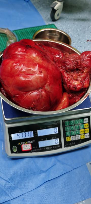 南昌大学第二附属医院胃肠外科毛盛勋教授团队成功完成一例后腹膜巨大脂肪肉瘤切除术