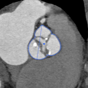 合肥京东方医院首例 TAVR 手术成功,心脏主动脉瓣置换现已进入「介入换新」时代