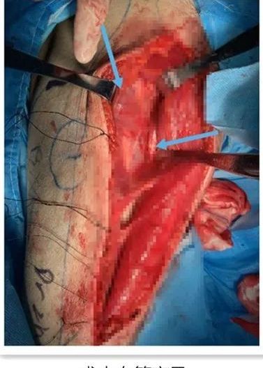 延安大学附属医院创伤骨科成功救治两例严重血管软组织损伤患者