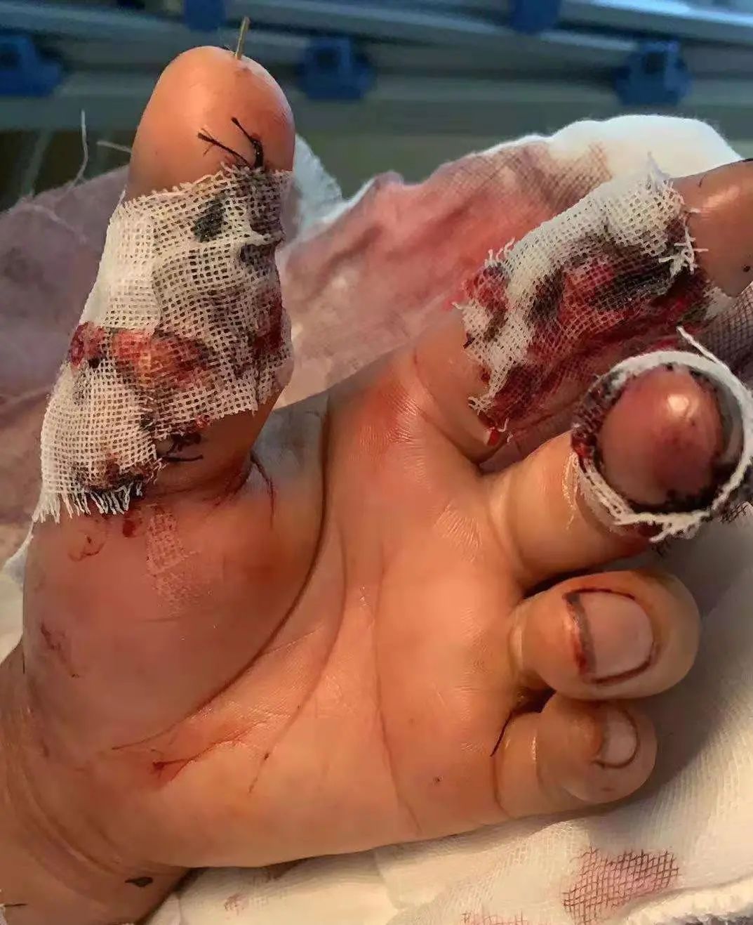 「移花接木」拇指再造，上海海华医院成功完成一例复杂拇指再造术