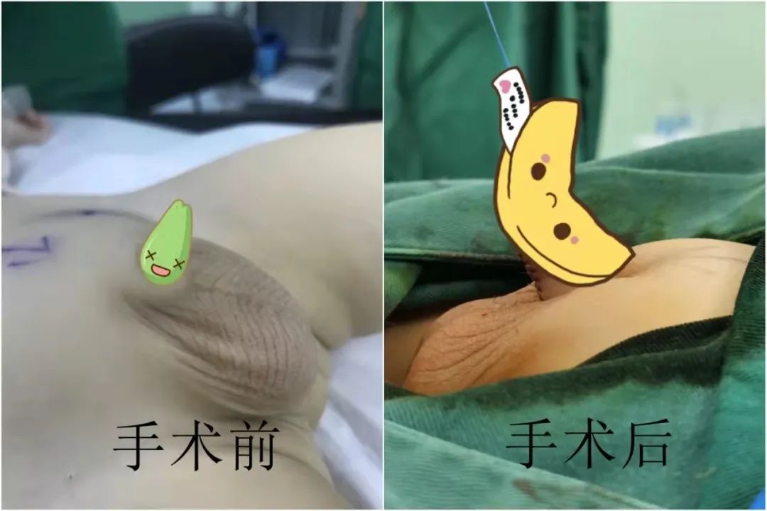 我的孩子出生时,小丁丁只有花生米大小