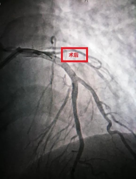 撑起生命通道：前海人寿广西医院心血管内科成功实施冠状动脉支架植入术