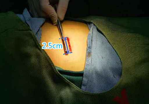 广西壮族自治区南溪山医院极致微创  2.5 厘米小创口解决胸腔大问题
