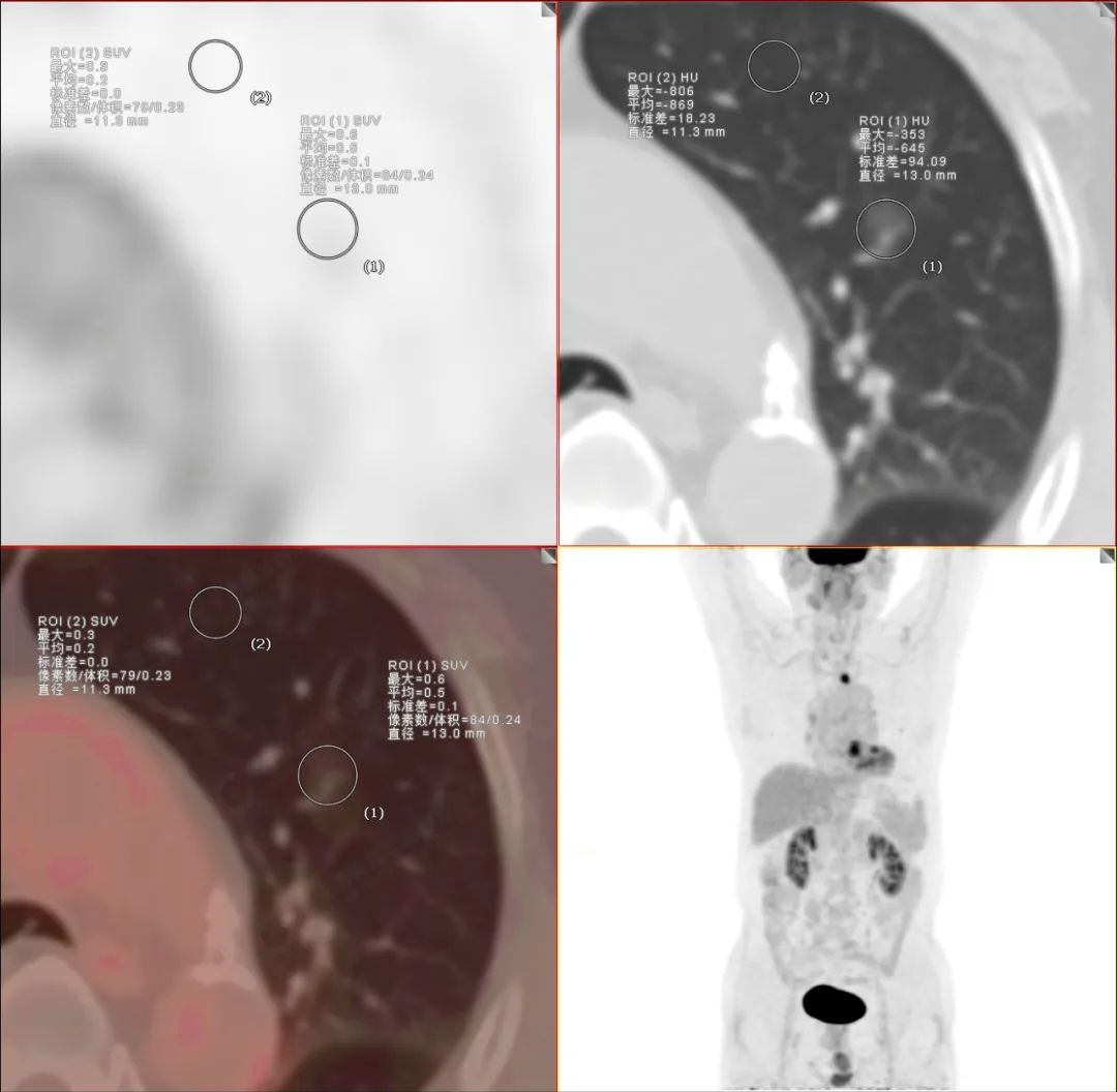 高尚病例：肺结节看诊，PET/CT「意外」发现食管癌一例