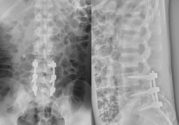 西安交通大学第二附属医院骨二科完成一例脊柱内镜下腰椎减压融合术