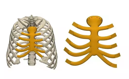 大医之术⑥｜胸腔外科与整形医院联合 3D 打印全胸骨置换胸廓成型术救治复发胸腺恶性肿瘤患者