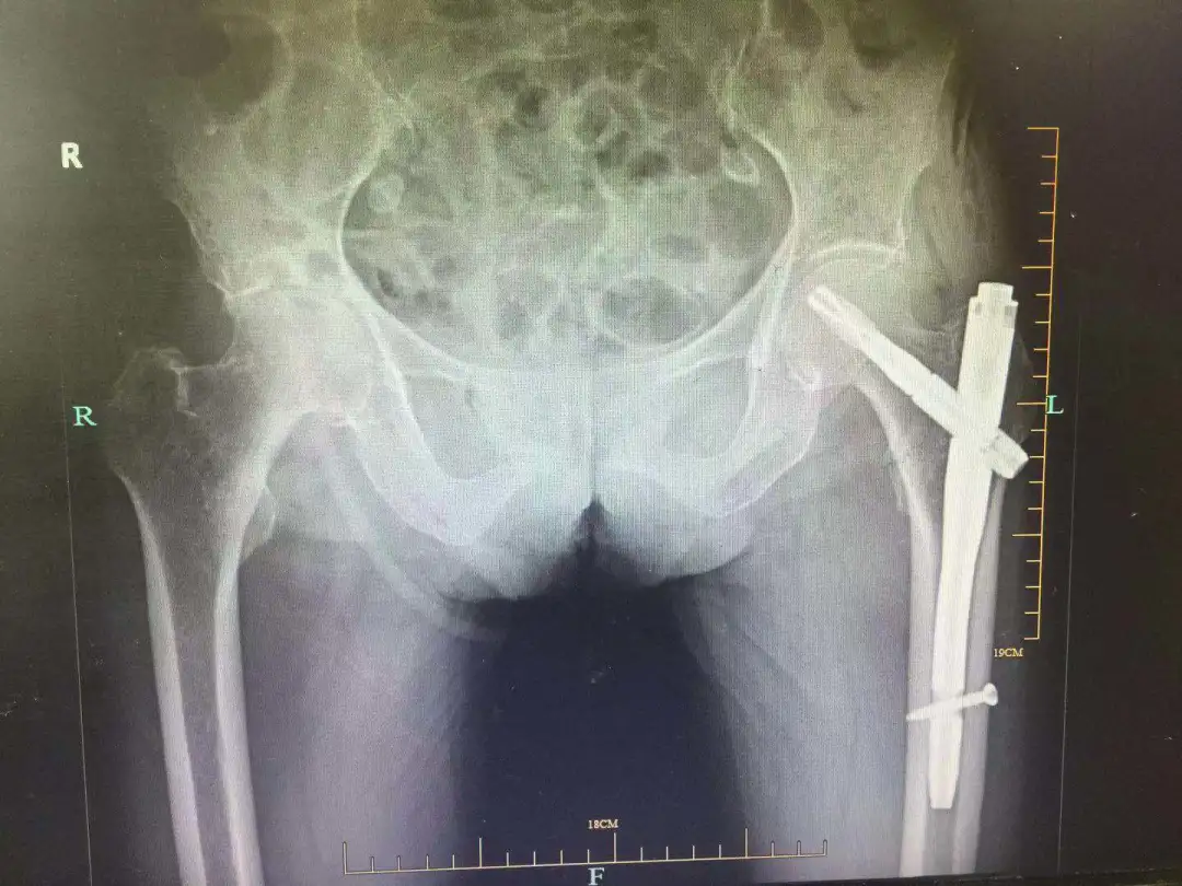 战胜「人生中的最后一次骨折」!上海海华医院多学科协作成功救治 3 名高龄骨折患者