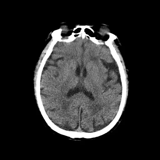重度中风，致残率高达 75%，7 旬老人却成功逃过偏瘫、失语后遗症