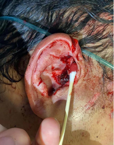 惊险！长约 6 CM 玻璃碎片刺入颅底，中南大学湘雅二医院耳鼻咽喉头颈外科成功将异物取出