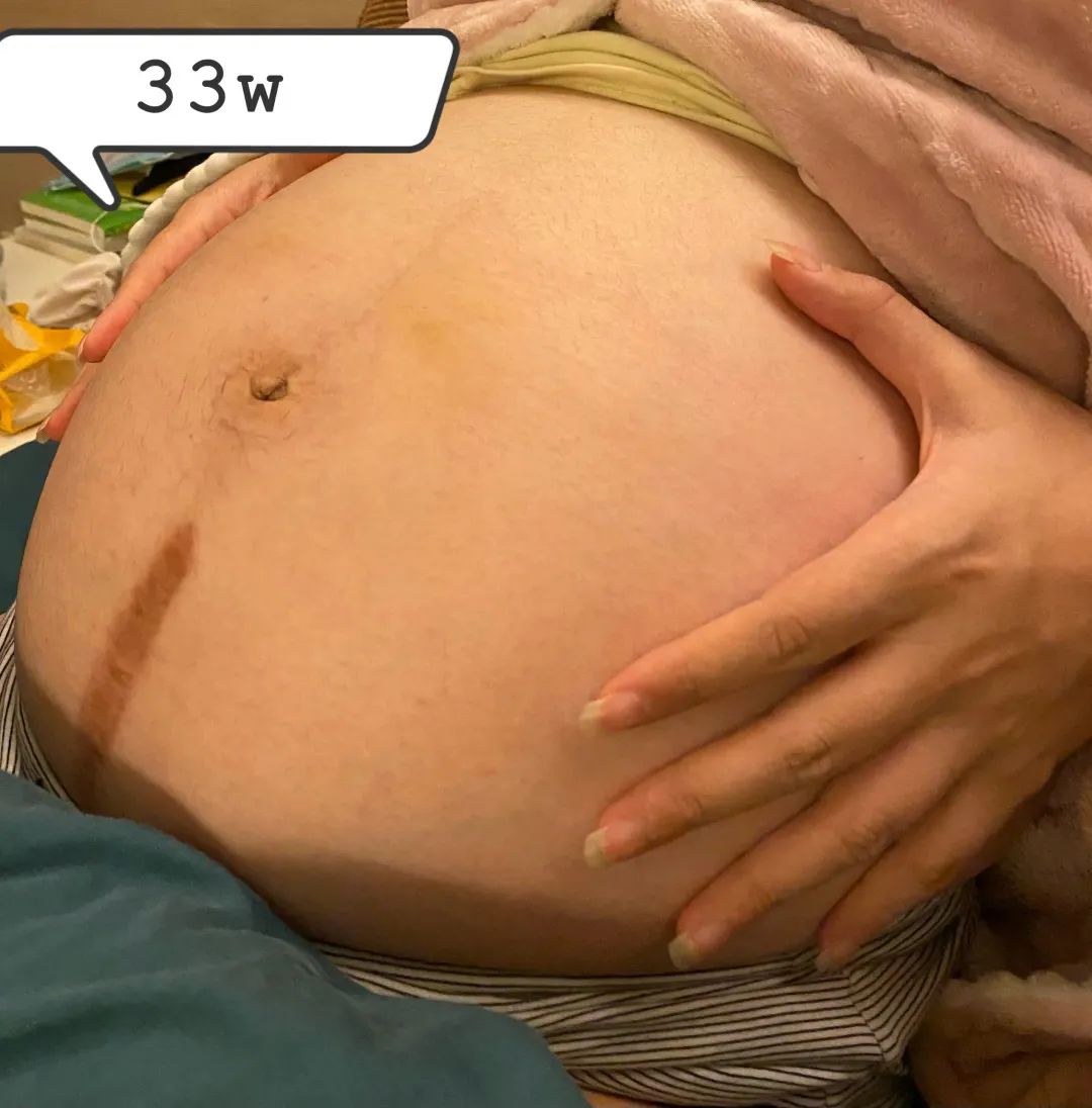 胎停后又艰难保胎：孕妈被扎 200 多针，才换来宝宝的平安出生
