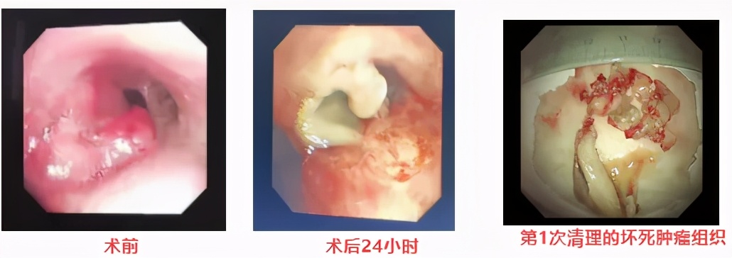 这一束光能让肺癌肿瘤细胞「见光死」