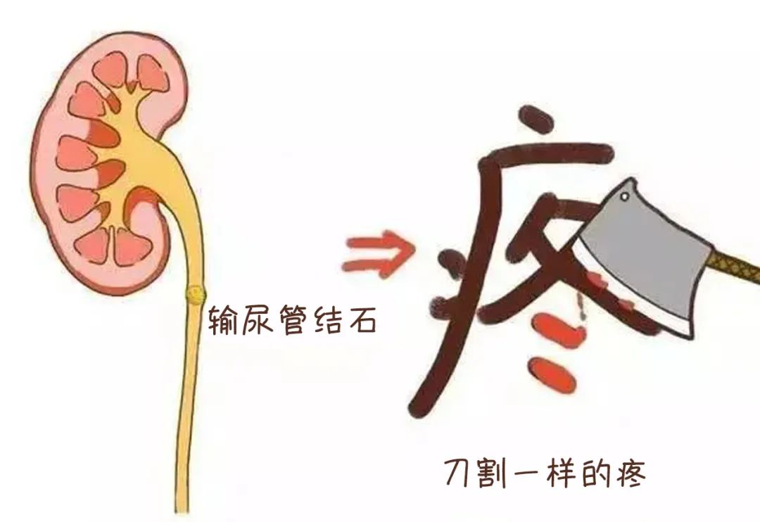 孕 6 个月的她，先后经历 2 次手术，只因为身体里的几颗「小石头」