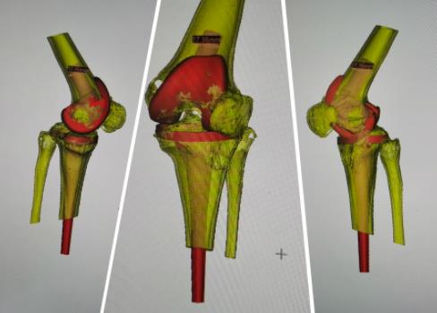 图为依据三维重建影像画出来的膝关节构造图图为 2017 年(右),2020 年