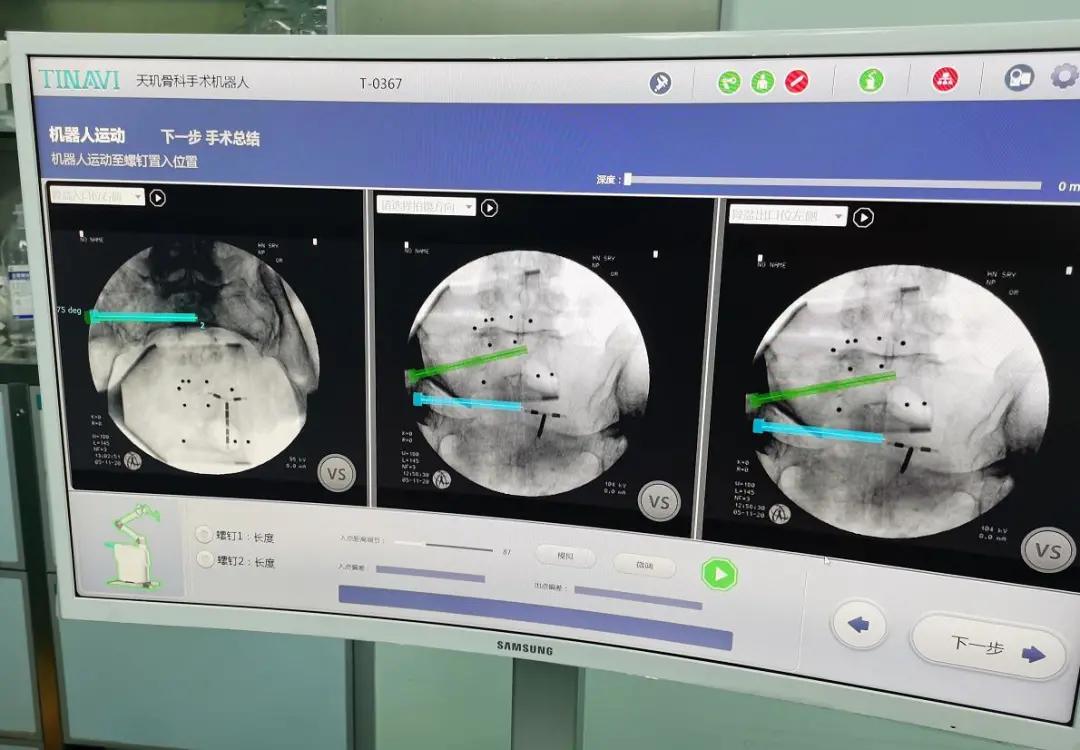 河南省人民医院完成河南省首例「天玑」机器人引导下骨折手术
