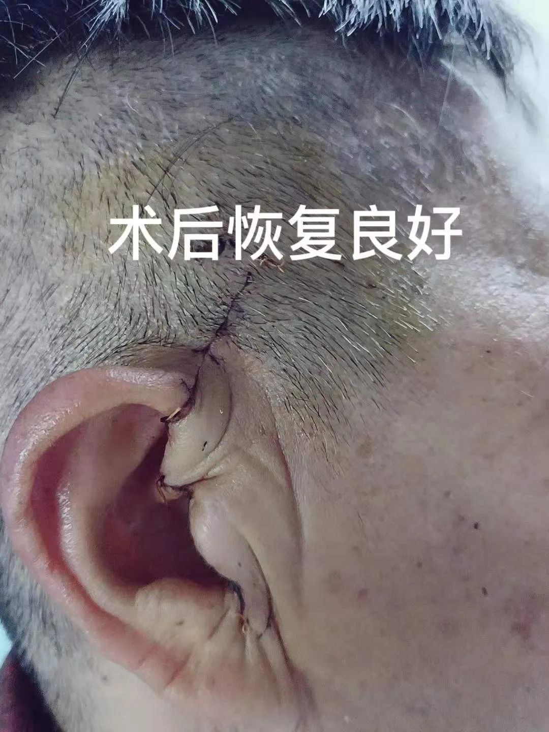 绵阳市第三人民医院甲状腺头颈颌面外科手术复位颞下颌关节紊乱
