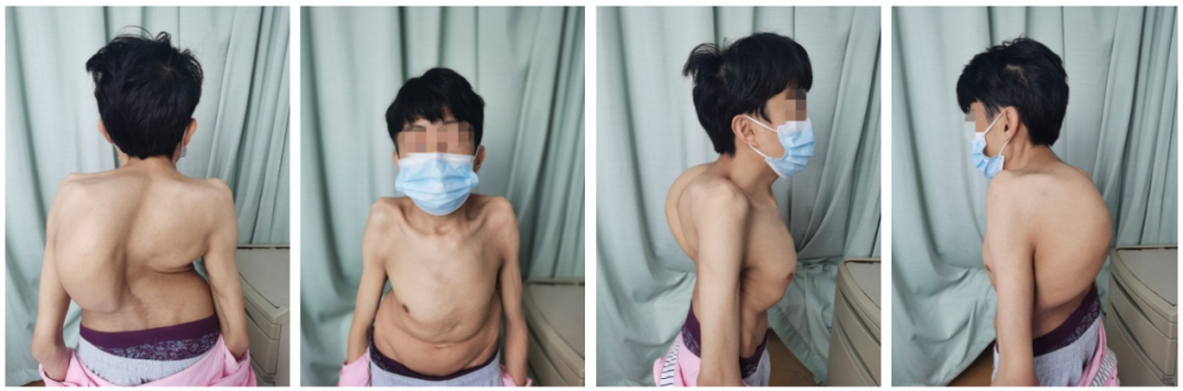 38 岁、137 CM、31 KG，重庆西南医院泌尿外科成功开展膀胱全切术