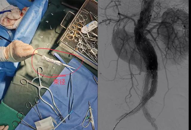 北大医疗鲁中医院胸心血管外科成功开展多种高精尖手术