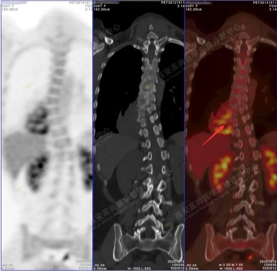 高尚病例：PET/CT-MR 诊断脊柱旁神经节细胞瘤一例