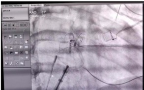 深圳市首例!龙岗区人民医院为房颤、房缺患者消除「隐形炸弹」!