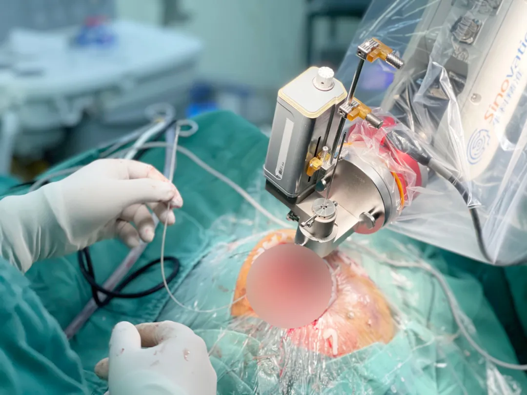 机器人辅助全麻无框架 DBS 手术在桂林医学院附属医院成功实施