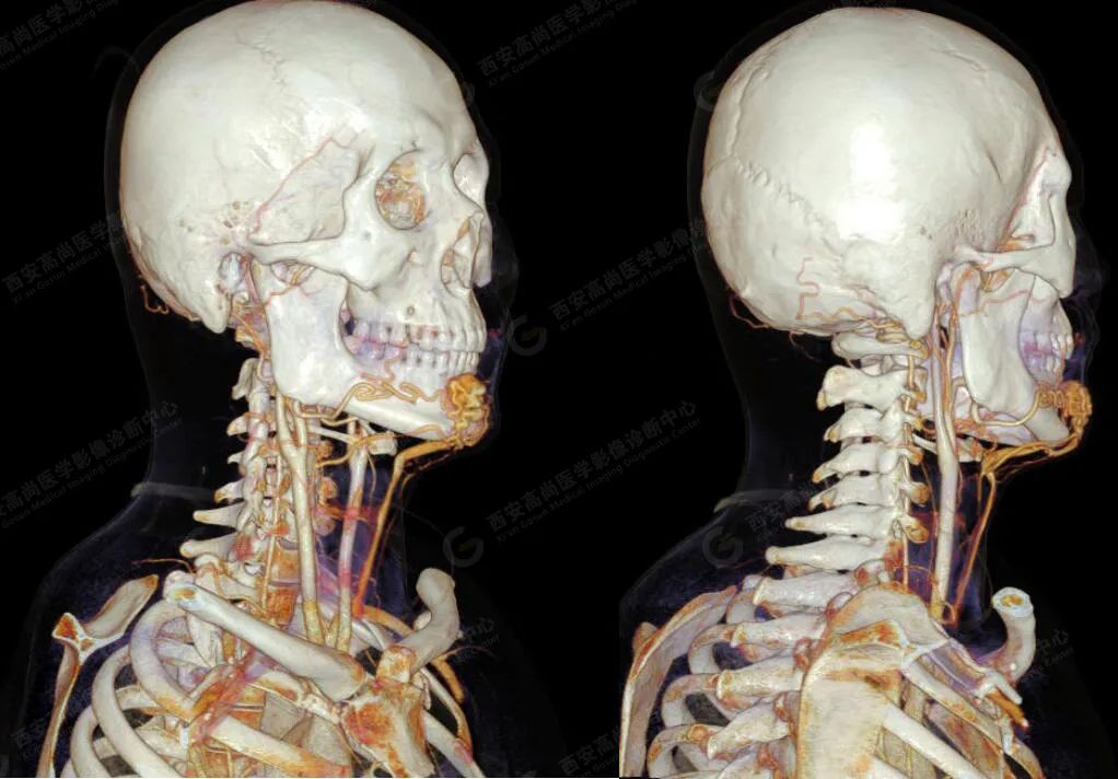 高尚病例：颌面部血管畸形 CTA、CTV 成像技术应用