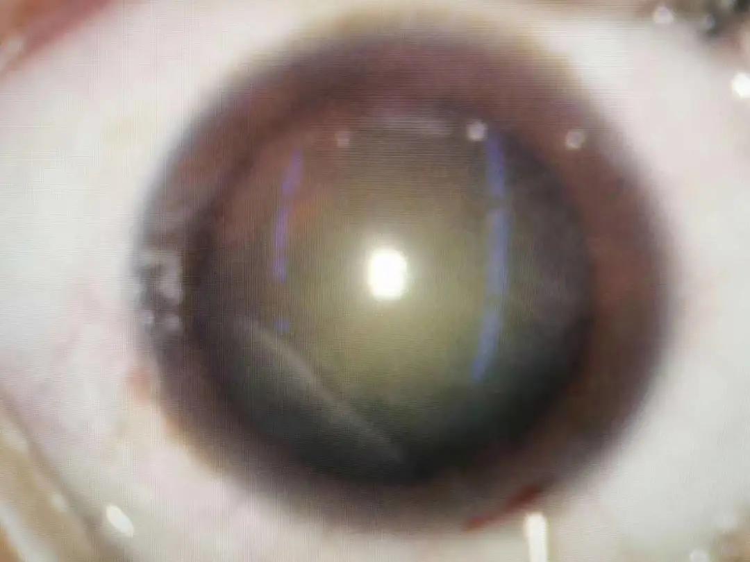 华润武钢总医院眼科成功实施首例连续视程人工晶体植入术