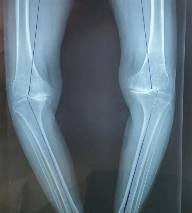 宁城县中心医院骨一科成功为一位高龄双膝重度骨性关节炎患者实施双膝关节表面置换术
