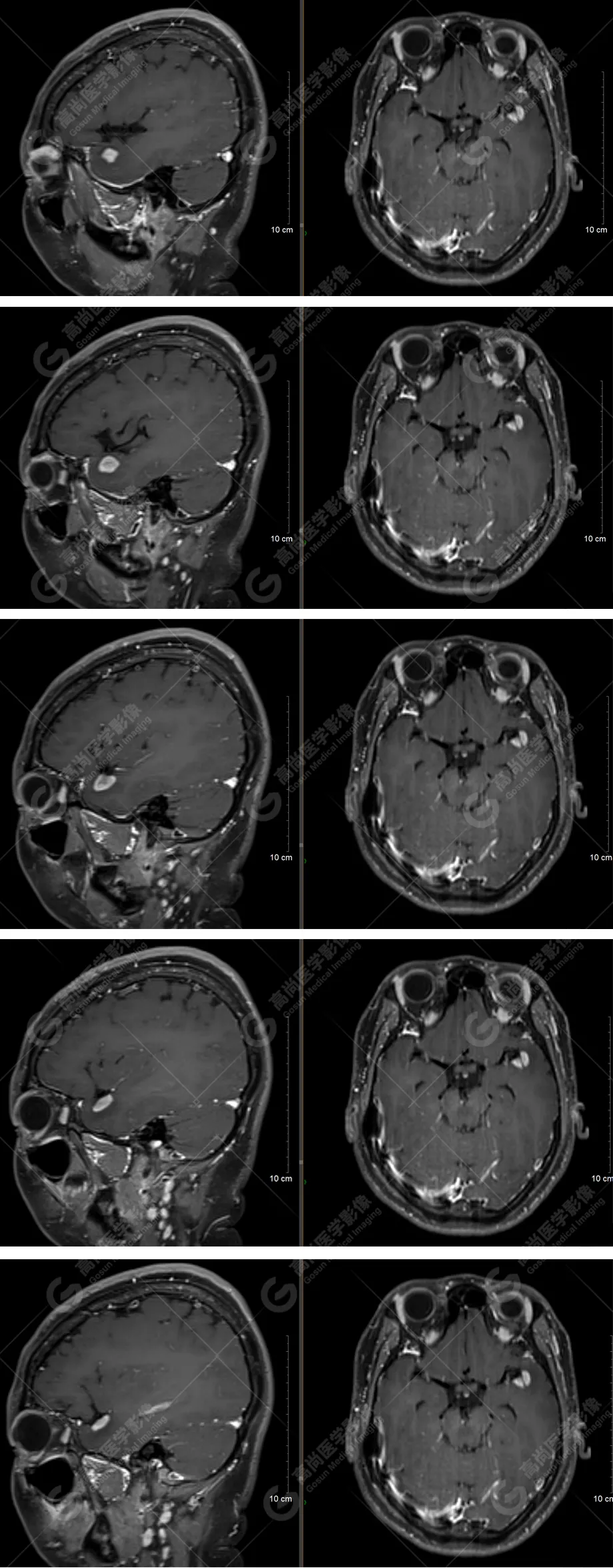 高尚病例：少见类型脑膜瘤回顾分析