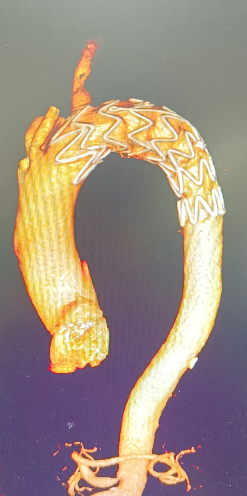 南京江北医院成功开展胸主动脉覆膜支架腔内隔绝术