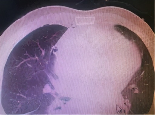 璧山区人民医院微创手术为患者切除 8 公分胸腔肿瘤